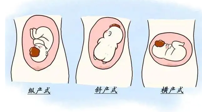 胎位lop示意图是什么样子的呢